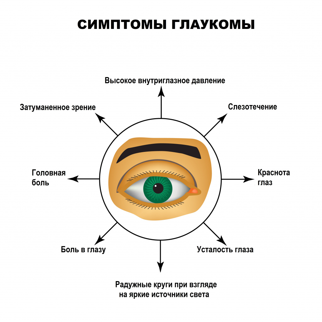Изображение &ndash; Симптомы глаукомы