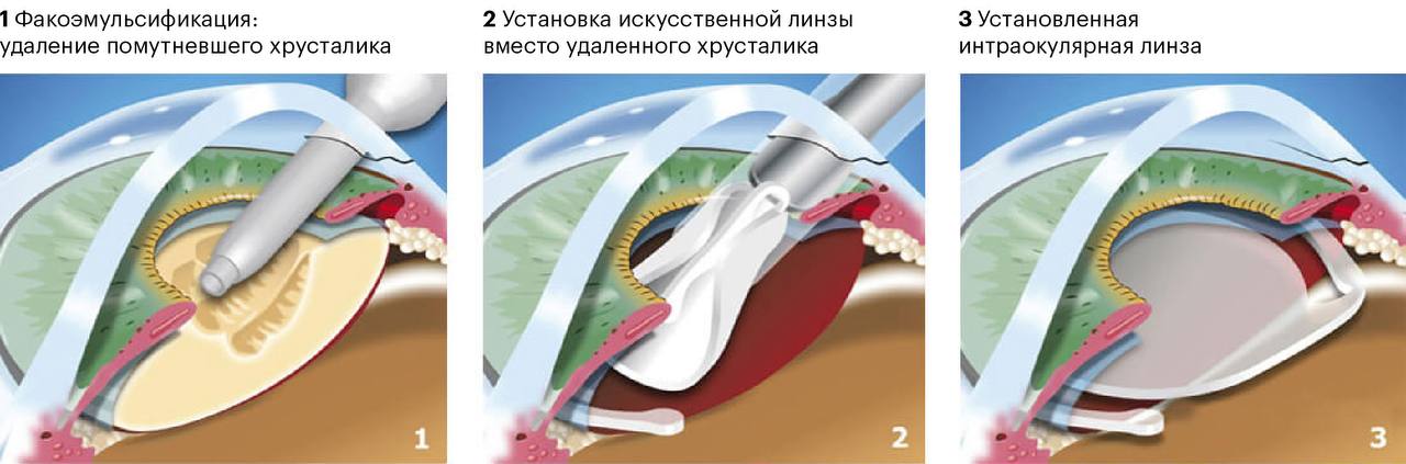 Изображение &mdash; Как проходит операция